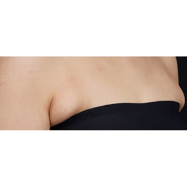 seios antes do ultraformer MTP 