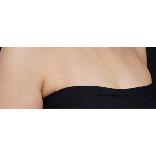 seios depois do ultraformer MPT