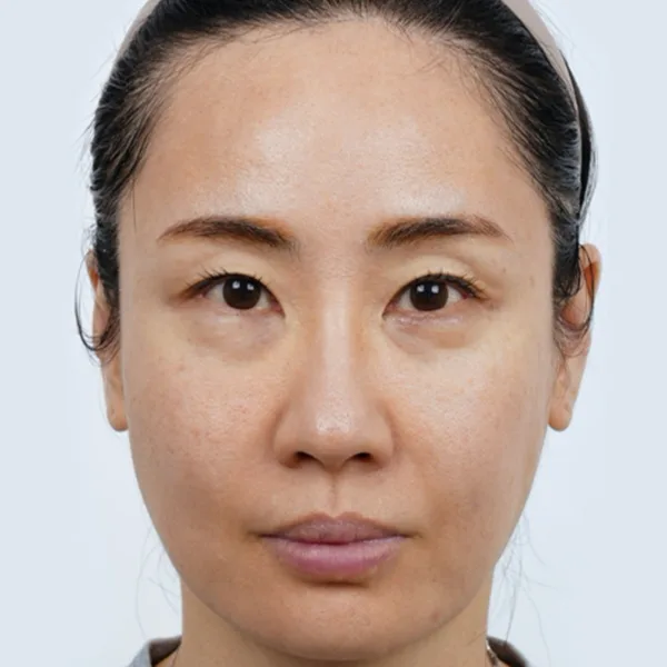 antes ultraformer MPT