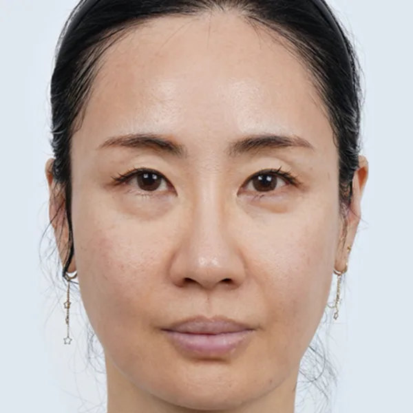 depois do ultraformer MPT