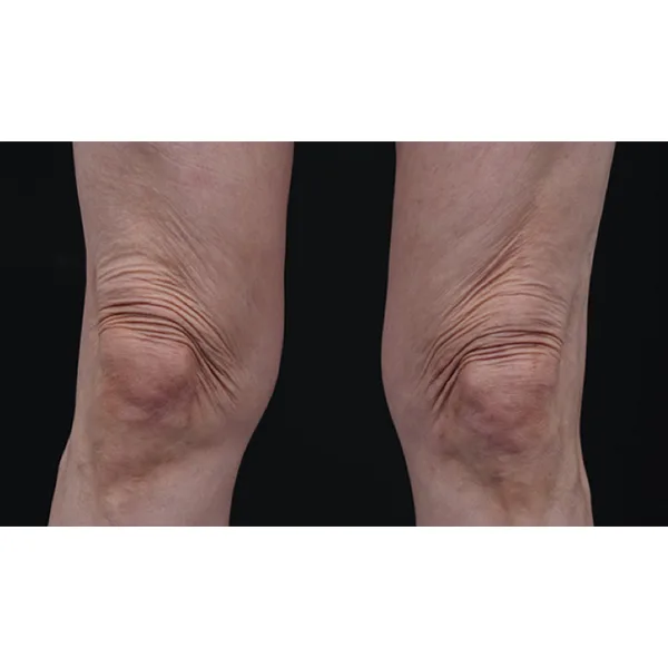 joelhos antes ultraformer MPT