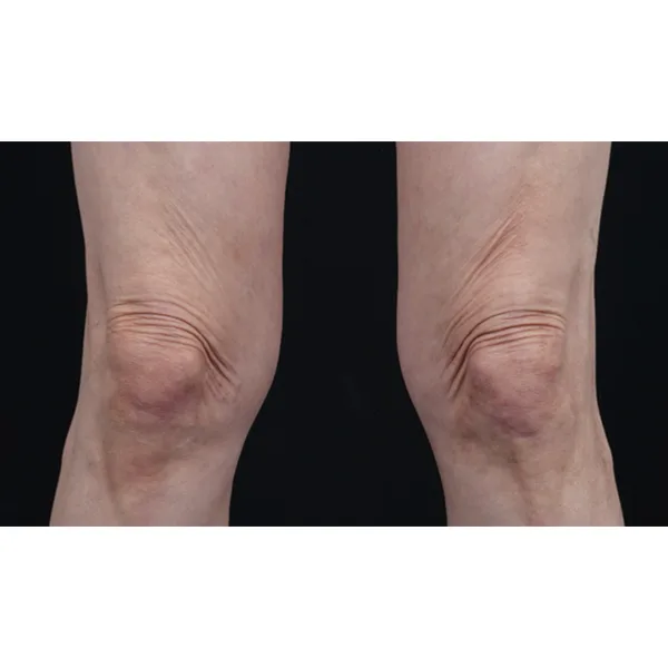 joelhos depois do ultraformer MPT